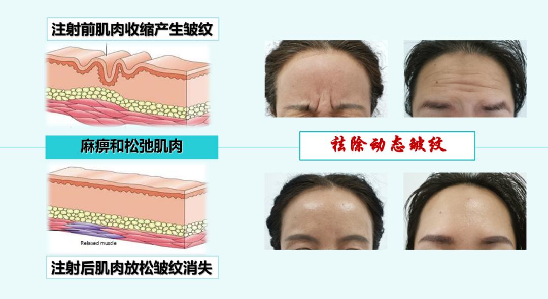 医者名片| 想打美容针?十条肉毒素“大起底”你不可不看!-第2张图片-ZBLOG 整形美容团队介绍文案_肉毒素瘦脸针效果_肉毒素注射除皱